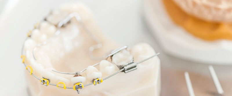 Kieferorthopädie Zahnspange Gebiss Modell